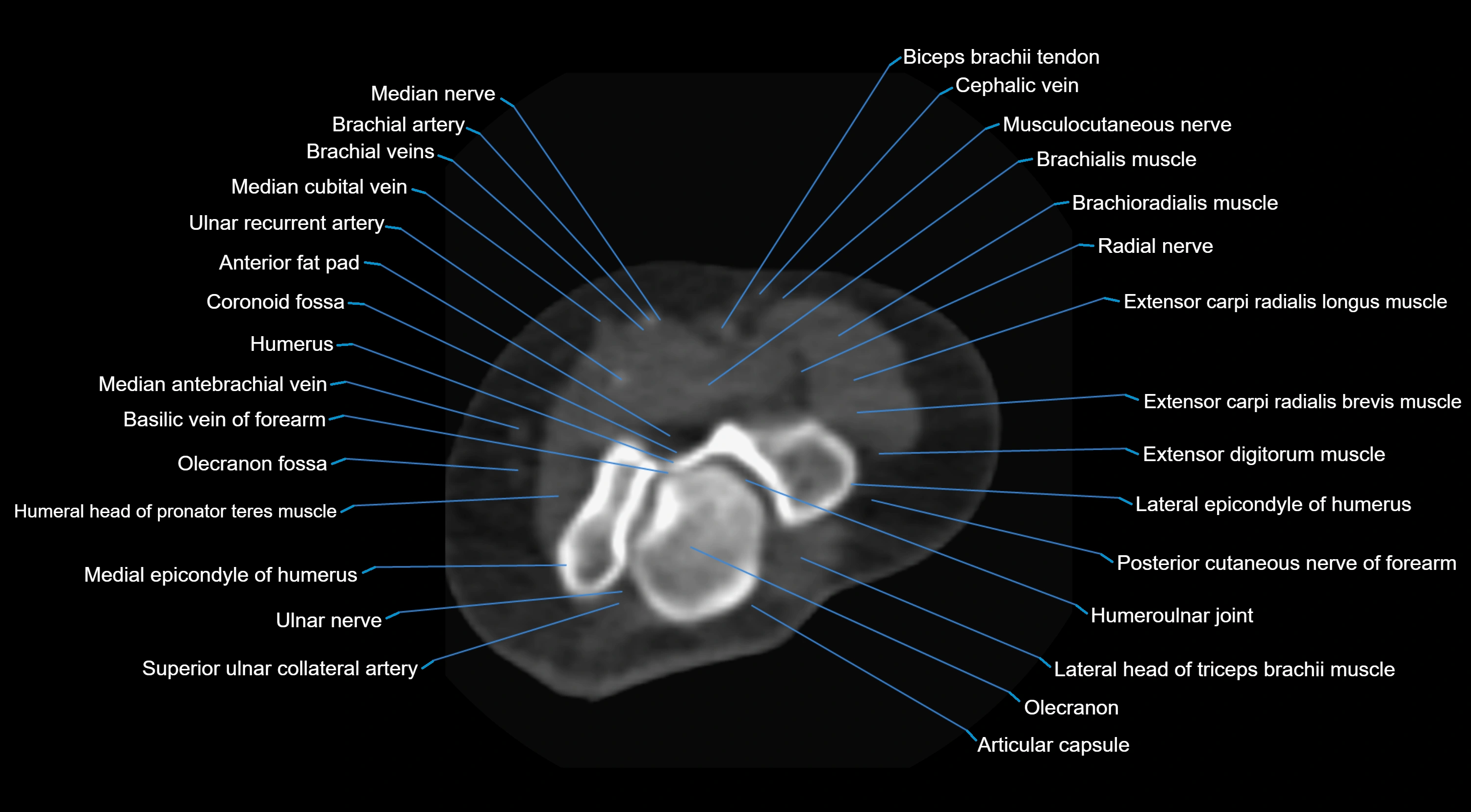 CT elbow axial  cross sectional anatomy labelled  radiology image -00018.webp
